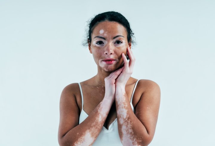 Vitiligo 1